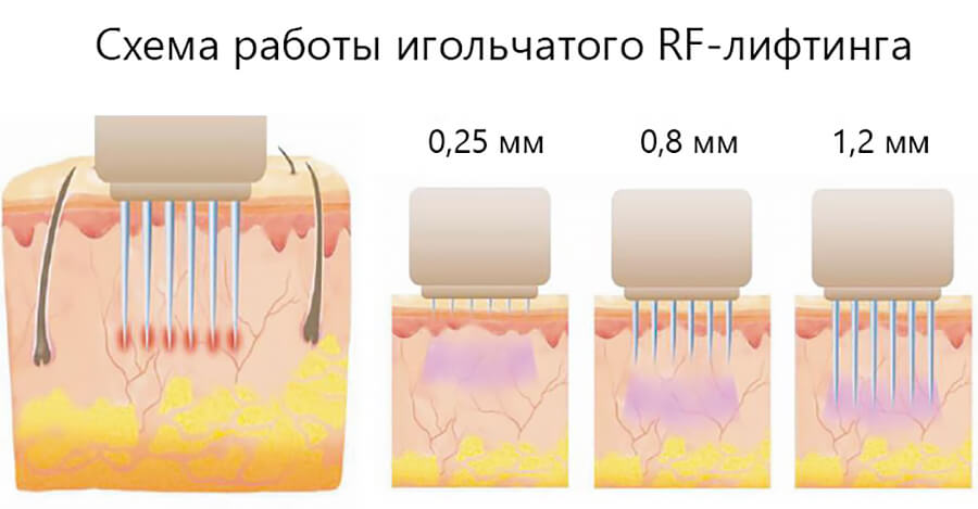 Схема работы микроигольчатого RF